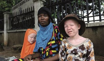 Afrikalı albinoların yaşamı İKÜSAG'da